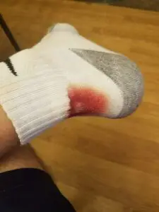 blister from nike socks